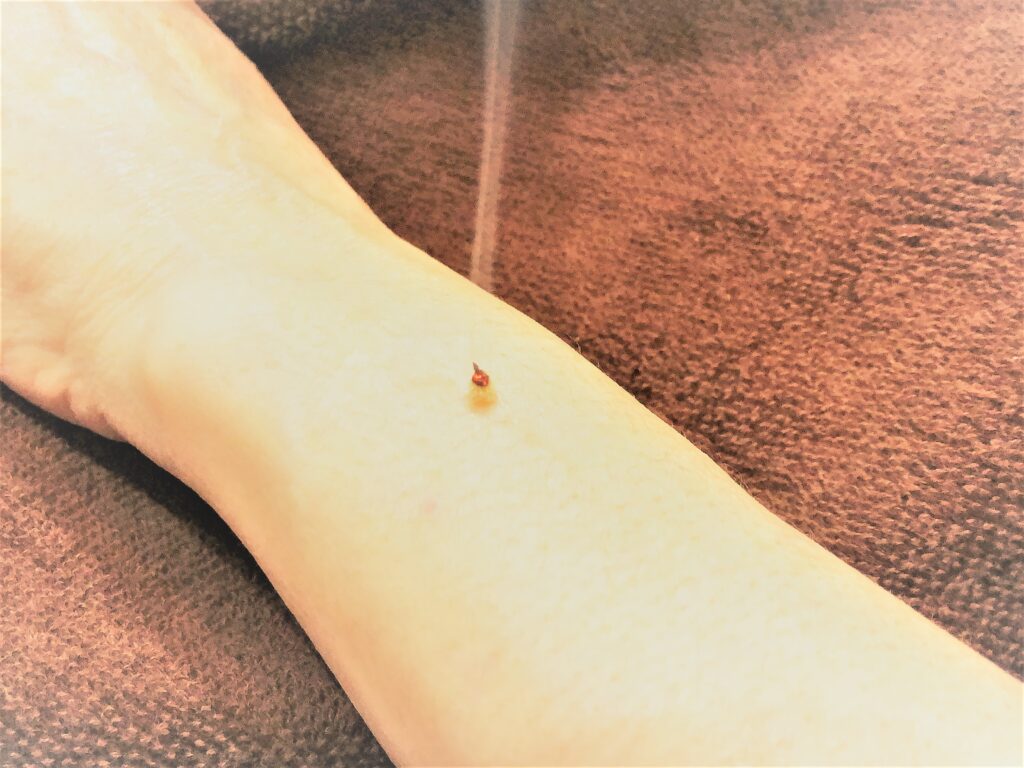 腕の灸治療